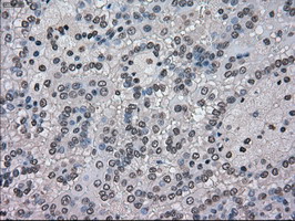 NEK6 Antibody - IHC of paraffin-embedded Carcinoma of kidney tissue using anti-NEK6 mouse monoclonal antibody. (Dilution 1:50).