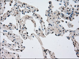 NEK6 Antibody - IHC of paraffin-embedded Carcinoma of lung tissue using anti-NEK6 mouse monoclonal antibody. (Dilution 1:50).