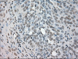 NEK6 Antibody - IHC of paraffin-embedded Adenocarcinoma of ovary tissue using anti-NEK6 mouse monoclonal antibody. (Dilution 1:50).