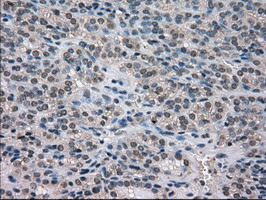 NEK6 Antibody - IHC of paraffin-embedded Carcinoma of thyroid tissue using anti-NEK6 mouse monoclonal antibody. (Dilution 1:50).