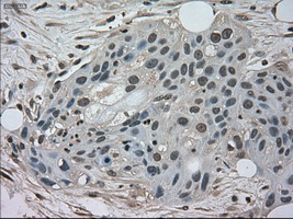NEK6 Antibody - IHC of paraffin-embedded Carcinoma of pancreas tissue using anti-NEK6 mouse monoclonal antibody. (Dilution 1:50).