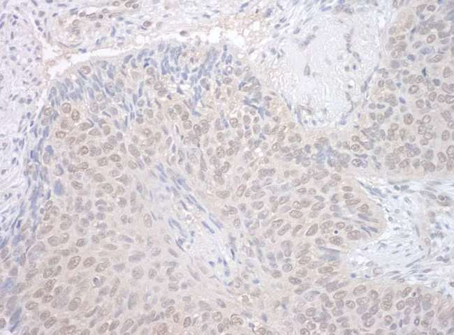 NEK7 Antibody - Detection of Human NEK7 by Immunohistochemistry. Sample: FFPE section of human non-small cell lung cancer. Antibody: Affinity purified rabbit anti-NEK7 used at a dilution of 1:250.