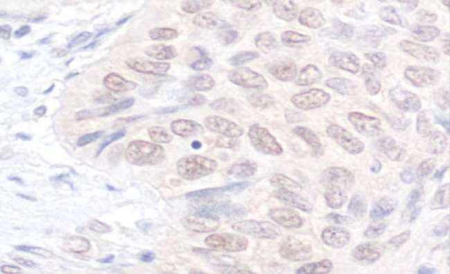 NEK7 Antibody - Detection of Human NEK7 by Immunohistochemistry. Sample: FFPE section of human lung carcinoma. Antibody: Affinity purified rabbit anti-NEK7 used at a dilution of 1:1000 (1 Detection: DAB.