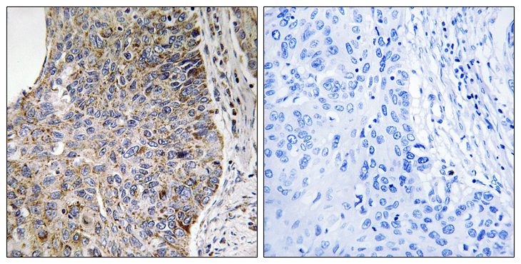 NEK7 Antibody - Immunohistochemistry analysis of paraffin-embedded human lung carcinoma tissue, using NEK7 Antibody. The picture on the right is blocked with the synthesized peptide.