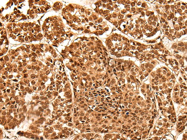 NEK7 Antibody - Immunohistochemistry of paraffin-embedded Human esophagus cancer tissue  using NEK7 Polyclonal Antibody at dilution of 1:60(×200)