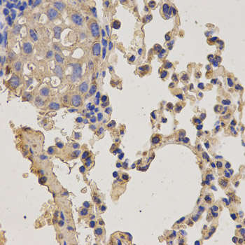 NEK8 Antibody - Immunohistochemistry of paraffin-embedded mouse lung cancer using NEK8 antibody at dilution of 1:200 (x400 lens).
