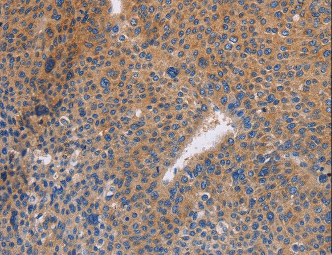 NEK8 Antibody - Immunohistochemistry of paraffin-embedded Human cervical cancer using NEK8 Polyclonal Antibody at dilution of 1:30.