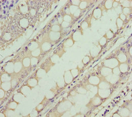 NEK8 Antibody - Immunohistochemistry of paraffin-embedded human colon cancer at dilution 1:100