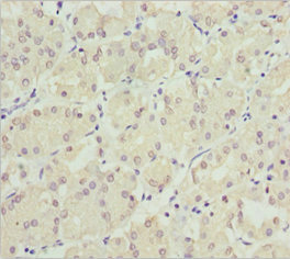 NEK8 Antibody - Immunohistochemistry of paraffin-embedded human gastric cancer at dilution 1:100