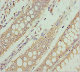 NEK8 Antibody - Immunohistochemistry of paraffin-embedded human colon cancer at dilution 1:100