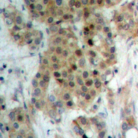 NEK9 Antibody - Immunohistochemical analysis of NEK9 (pT210) staining in human breast cancer formalin fixed paraffin embedded tissue section. The section was pre-treated using heat mediated antigen retrieval with sodium citrate buffer (pH 6.0). The section was then incubated with the antibody at room temperature and detected using an HRP conjugated compact polymer system. DAB was used as the chromogen. The section was then counterstained with hematoxylin and mounted with DPX.