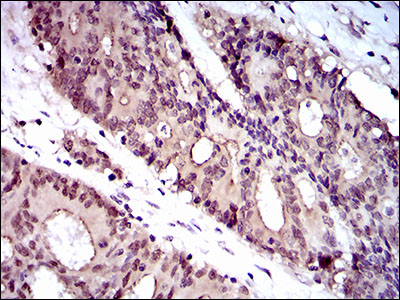 NELFA / WHSC2 Antibody - IHC of paraffin-embedded colon cancer tissues using WHSC2 mouse monoclonal antibody with DAB staining.