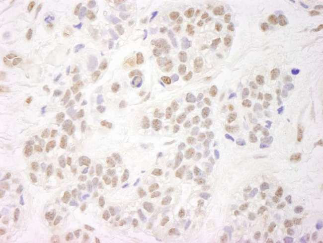 NELFA / WHSC2 Antibody - Detection of Human NELFA by Immunohistochemistry. Sample: FFPE section of human breast carcinoma. Antibody: Affinity purified rabbit anti-NELFA used at a dilution of 1:250.