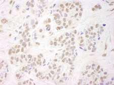 NELFA / WHSC2 Antibody - Detection of Human NELFA by Immunohistochemistry. Sample: FFPE section of human breast carcinoma. Antibody: Affinity purified rabbit anti-NELFA used at a dilution of 1:250.