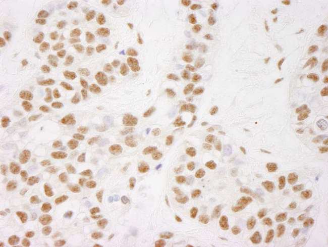 NELFB / COBRA1 Antibody - Detection of Human COBRA1 by Immunohistochemistry. Sample: FFPE section of human breast carcinoma. Antibody: Affinity purified rabbit anti-COBRA1 used at a dilution of 1:250.