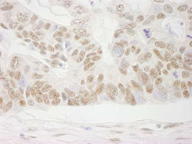 NELFB / COBRA1 Antibody - Detection of Human COBRA1 by Immunohistochemistry. Sample: FFPE section of human ovarian carcinoma. Antibody: Affinity purified rabbit anti-COBRA1 used at a dilution of 1:250.
