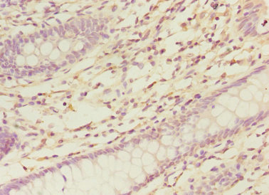NELFB / COBRA1 Antibody - Immunohistochemistry of paraffin-embedded human colon cancer using NELFB Antibody at dilution of 1:100