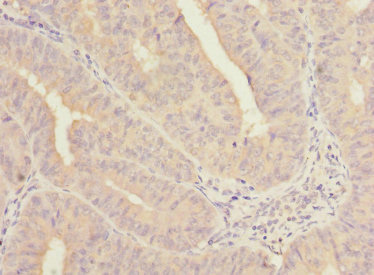 NELFB / COBRA1 Antibody - Immunohistochemistry of paraffin-embedded human endometrial cancer using NELFB Antibody at dilution of 1:100