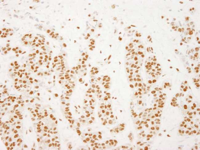 NELFE / RD / RDBP Antibody - Detection of Human NELFE by Immunohistochemistry. Sample: FFPE section of human breast carcinoma. Antibody: Affinity purified rabbit anti-NELFE used at a dilution of 1:250.