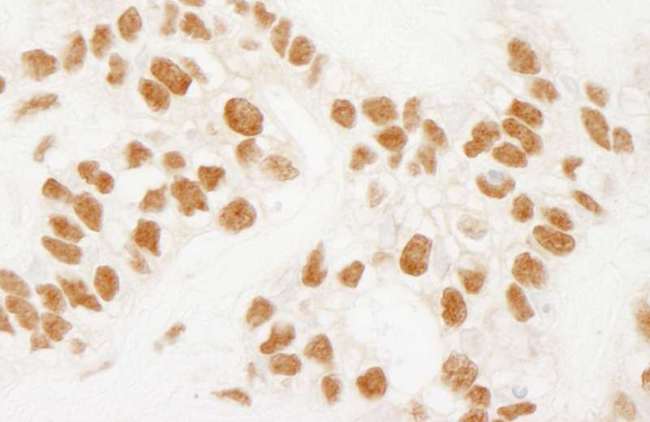 NELFE / RD / RDBP Antibody - Detection of Human NELFE by Immunohistochemistry. Sample: FFPE section of human ovarian carcinoma. Antibody: Affinity purified rabbit anti-NELFE used at a dilution of 1:1000 (1 ug/ml). Detection: DAB.
