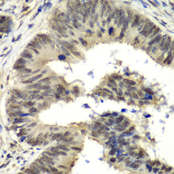 NELFE / RD / RDBP Antibody - Immunohistochemistry of paraffin-embedded human colon carcinoma tissue.