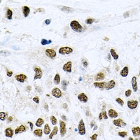 NELFE / RD / RDBP Antibody - Immunohistochemical analysis of NELF-E staining in human lung cancer formalin fixed paraffin embedded tissue section. The section was pre-treated using heat mediated antigen retrieval with sodium citrate buffer (pH 6.0). The section was then incubated with the antibody at room temperature and detected using an HRP conjugated compact polymer system. DAB was used as the chromogen. The section was then counterstained with hematoxylin and mounted with DPX.