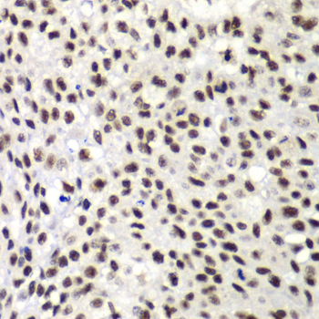 NELFE / RD / RDBP Antibody - Immunohistochemistry of paraffin-embedded human lung cancer using NELFE antibody at dilution of 1:100 (40x lens).