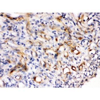 NES / Nestin Antibody - Nestin was detected in paraffin-embedded sections of human melanoma tissues using rabbit anti- Nestin Antigen Affinity purified polyclonal antibody at 1 ug/mL. The immunohistochemical section was developed using SABC method.