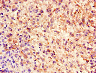NES / Nestin Antibody - Immunohistochemistry of paraffin-embedded human melanoma using NES Monoclonal Antibody at dilution of 1:100