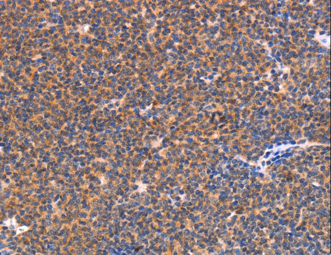 NES / Nestin Antibody - Immunohistochemistry of paraffin-embedded Human lymphoma using NES Polyclonal Antibody at dilution of 1:30.