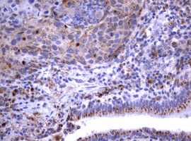 NEU1 / NEU Antibody - IHC of paraffin-embedded Carcinoma of Human lung tissue using anti-NEU1 mouse monoclonal antibody.