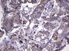 NEU1 / NEU Antibody - IHC of paraffin-embedded Adenocarcinoma of Human breast tissue using anti-NEU1 mouse monoclonal antibody.