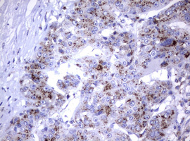 NEU1 / NEU Antibody - IHC of paraffin-embedded Carcinoma of Human liver tissue using anti-NEU1 mouse monoclonal antibody.
