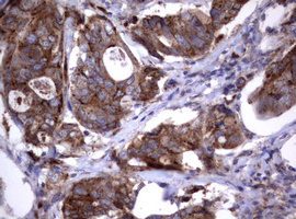 NEU1 / NEU Antibody - IHC of paraffin-embedded Adenocarcinoma of Human breast tissue using anti-NEU1 mouse monoclonal antibody.