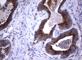 NEU1 / NEU Antibody - IHC of paraffin-embedded Adenocarcinoma of Human colon tissue using anti-NEU1 mouse monoclonal antibody.