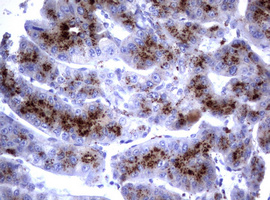 NEU1 / NEU Antibody - IHC of paraffin-embedded Carcinoma of Human liver tissue using anti-NEU1 mouse monoclonal antibody.
