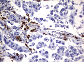 NEU1 / NEU Antibody - IHC of paraffin-embedded Carcinoma of Human bladder tissue using anti-NEU1 mouse monoclonal antibody.