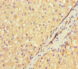 NEU1 / NEU Antibody - Immunohistochemistry of paraffin-embedded human liver cancer using NEU1 Antibody at dilution of 1:100
