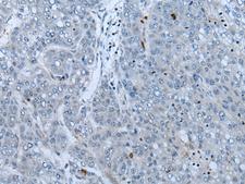 Neurofibromin / NF1 Antibody - Immunohistochemistry of paraffin-embedded Human liver cancer tissue  using NF1 Polyclonal Antibody at dilution of 1:65(×200)