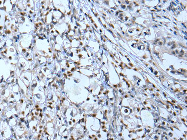 Neurofibromin / NF1 Antibody - Immunohistochemistry of paraffin-embedded Human gastric cancer tissue  using NF1 Polyclonal Antibody at dilution of 1:65(×200)