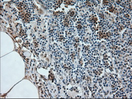 NEUROG1 / NGN1 / Neurogenin 1 Antibody - Immunohistochemical staining of paraffin-embedded Carcinoma of bladder tissue using anti-Immunohistochemical staining of paraffin-embedded breast tissue using anti-NEUROG1 mouse monoclonal antibody. (Dilution 1:50) mouse monoclonal antibody. (NEUROG1, Dil