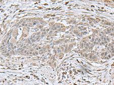 NEUROG3 / NGN3 / Neurogenin 3 Antibody - Immunohistochemistry of paraffin-embedded Human esophagus cancer tissue  using NEUROG3 Polyclonal Antibody at dilution of 1:70(×200)