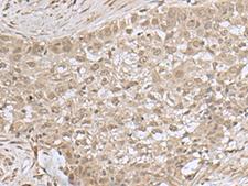 NEUROG3 / NGN3 / Neurogenin 3 Antibody - Immunohistochemistry of paraffin-embedded Human esophagus cancer tissue  using NEUROG3 Polyclonal Antibody at dilution of 1:55(×200)