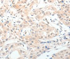 Neuropeptide Y / NPY Antibody - Immunohistochemistry of paraffin-embedded human lung cancer tissue.