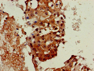 Neuroserpin Antibody - Immunohistochemistry of paraffin-embedded human breast cancer at dilution of 1:100