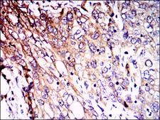 NF-L / NEFL Antibody - IHC of paraffin-embedded lung cancer tissues using NEFL mouse monoclonal antibody with DAB staining.