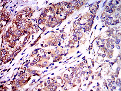 NF-L / NEFL Antibody - IHC of paraffin-embedded bladder cancer tissues using NEFL mouse monoclonal antibody with DAB staining.