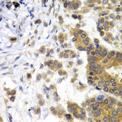 NF-L / NEFL Antibody - Immunohistochemistry of paraffin-embedded human breast cancer using NEFL antibodyat dilution of 1:200 (40x lens).