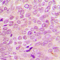 NF2 / Merlin Antibody - Immunohistochemical analysis of Merlin staining in human breast cancer formalin fixed paraffin embedded tissue section. The section was pre-treated using heat mediated antigen retrieval with sodium citrate buffer (pH 6.0). The section was then incubated with the antibody at room temperature and detected using an HRP conjugated compact polymer system. DAB was used as the chromogen. The section was then counterstained with hematoxylin and mounted with DPX.