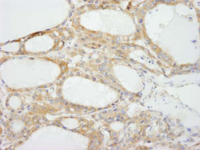 NF2 / Merlin Antibody - Detection of Human NF2 isoform 1 by Immunohistochemistry. Sample: FFPE section of human thyroid carcinoma. Antibody: Affinity purified rabbit anti-NF2 isoform 1 used at a dilution of 1:500.